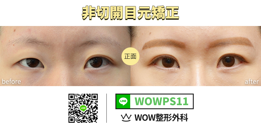 韓国プチ整形