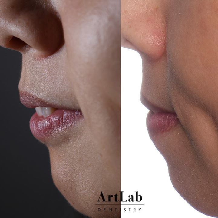 ArtLabDentistry's tweet photo. The beautiful transformation is the obvious part of this case, but true precision and engineering went into it to provide the lip support and achieve the highest function possible. https://t.co/TGN6zdFG4r #prosthodontist #newsmile #artlabdentistry https://t.co/PKForu3M77