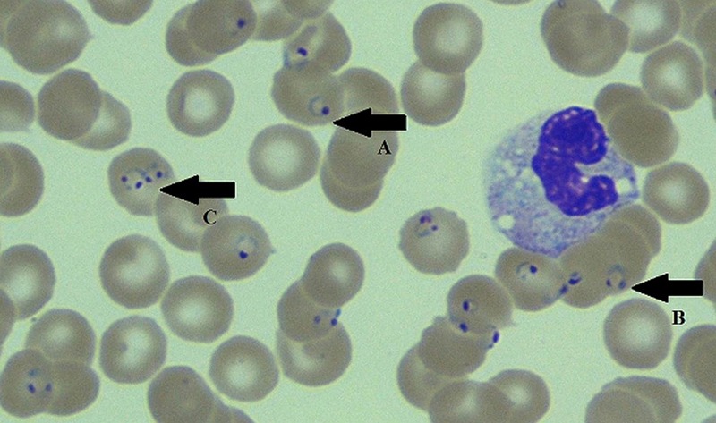 Малярия клетки. Falciparum малярия. Плазмодиум малярия. Плазмодий фальципарум. P falciparum малярия.