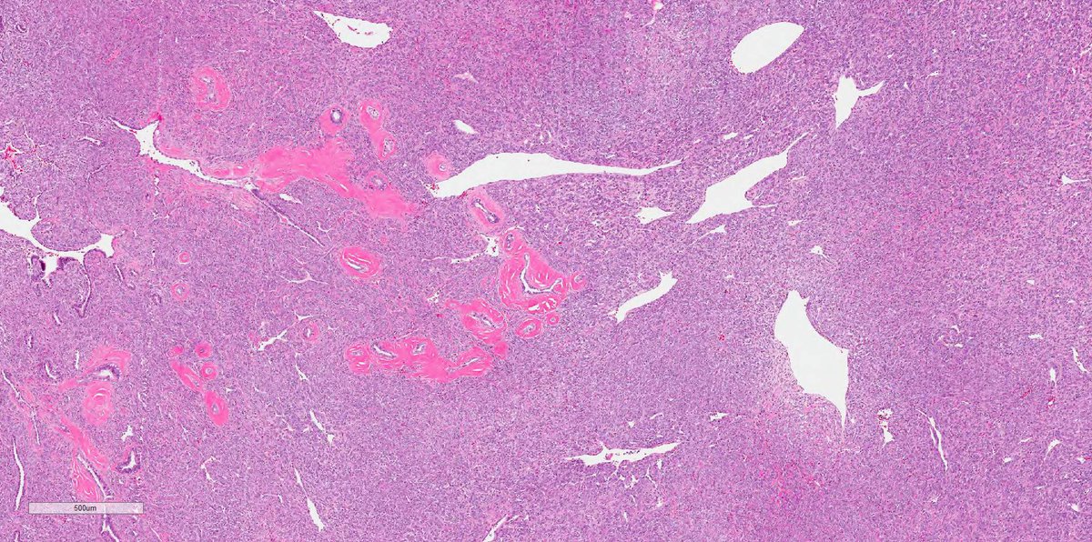 smlungpathguy's tweet photo. #USCAP2020 special!
O brave and wise tweeples, here is a special case to challenge the brave and the wise who are gathered in Los Angeles this week. High mags to follow.
#pathology #pulmpath https://t.co/CDozMGZrot