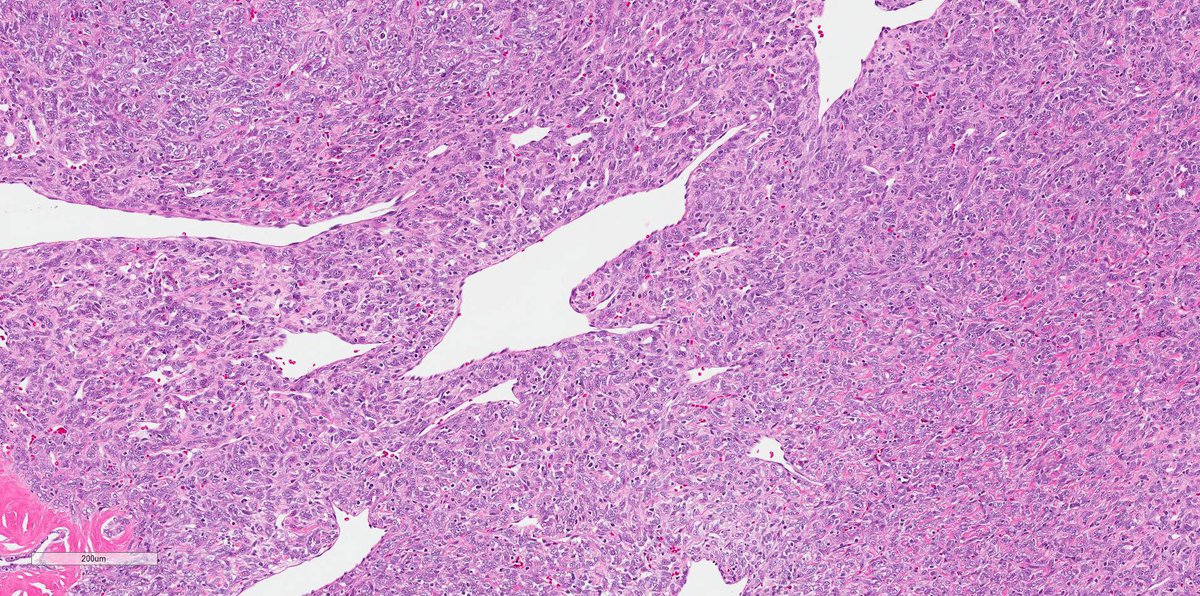 smlungpathguy's tweet photo. #USCAP2020 special!
O brave and wise tweeples, here is a special case to challenge the brave and the wise who are gathered in Los Angeles this week. High mags to follow.
#pathology #pulmpath https://t.co/CDozMGZrot