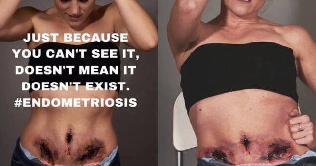 oph__lie's tweet photo. Mars est le mois de lutte contre l'endometriose. Pour toutes ces femmes qui souffrent au quotidien d'une maladie qu'on ne voit pas. Pour toutes celles à qui on dit "c'est normal d'avoir mal". Non ce n'est pas normal, vous n'êtes pas "folles" 
#Endometriosisawarenessmonth https://t.co/GiJifmePlU
