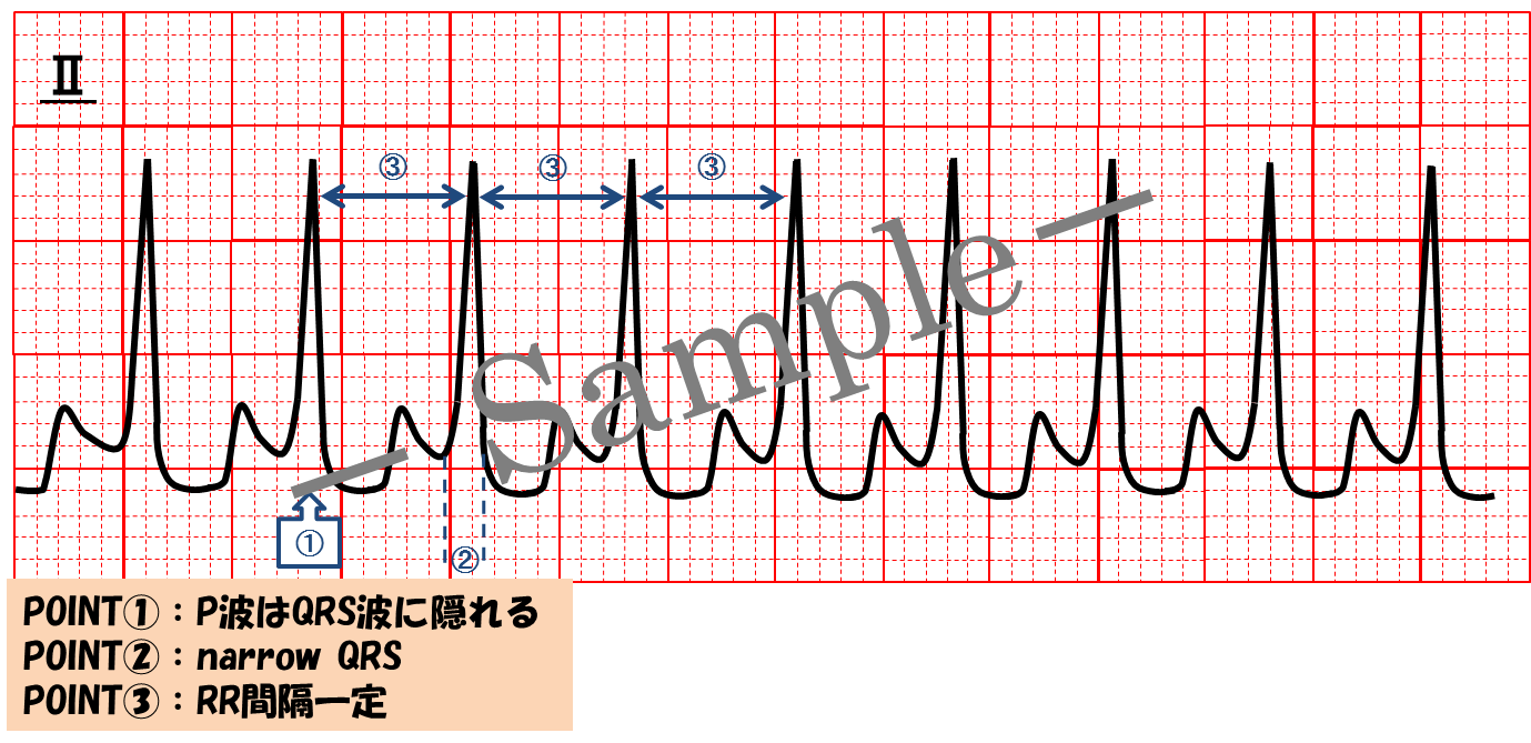 鍋 Ceme Jpeg フリー素材医ラストプラセボ管理人 ブログアップしました 心電図イラスト 房室結節リエントリー頻拍 Avnrt 心電図検定 心電図 心電図イラスト 臨床工学技士 T Co Okatay7y6n 鍋 Ceme Jpeg フリー素材医ラストプラセボ管理人 ブログアップしました 心電図イラスト 房室結節リエントリー頻拍 Avnrt 心電図検定 心電図 心電図イラスト 臨床工学技士 T Co Okatay7y6n