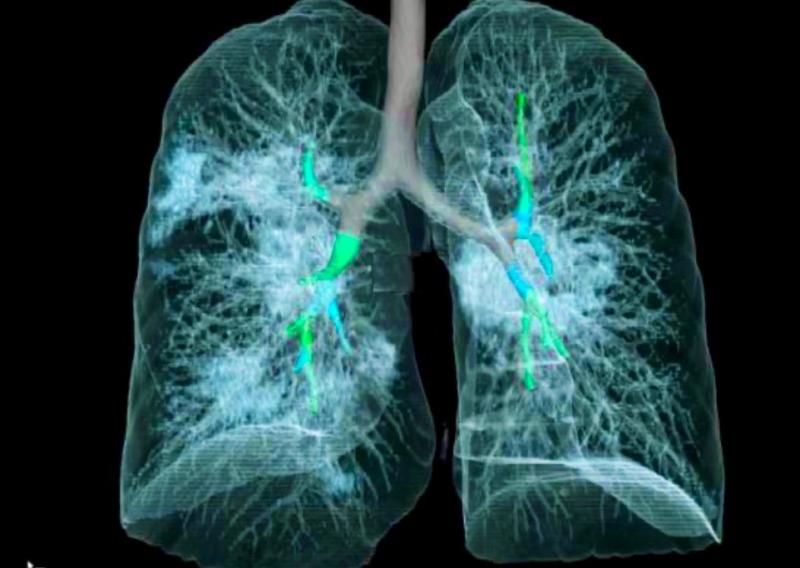 sallyeaves's tweet photo. New #DeepLearning model detects #coronavirus pneumonia from #CT scans with comparable performance to expert radiologists #COVID19 This #AI could help improve evaluation efficiency &amp; diagnosis. Preprint: https://t.co/1U51yvuXWS #TechForGood 
#artificialintelligence #healthcare https://t.co/SKtqIsPPej