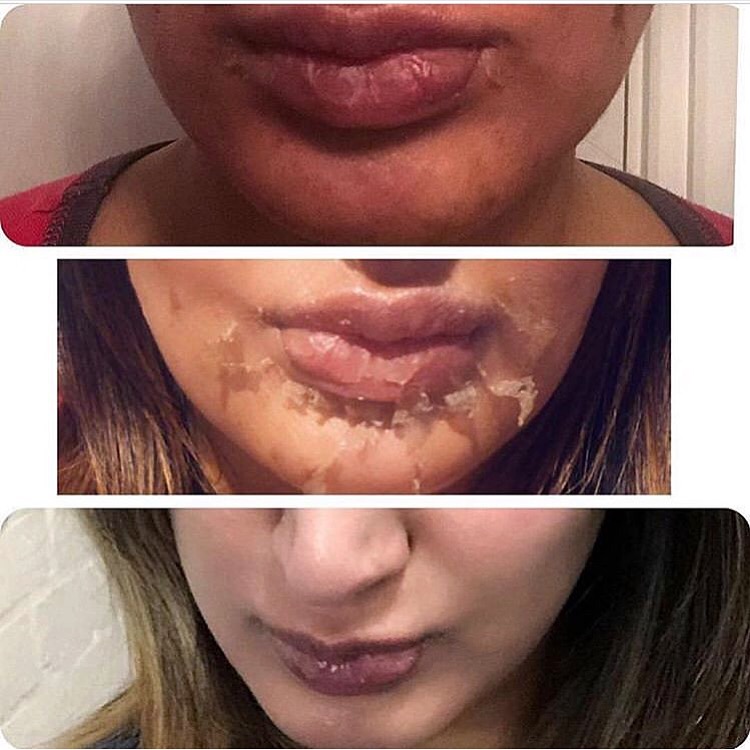 ThePerfectPeel's tweet photo. Hands up if you’re LOVING these before and after results from @elegantaestheticbeautyclinic after The Perfect Peel treatment?! 🙌🏼🙌🏼🙌🏼🙌🏼🙌🏼 #ThePerfectPeel https://t.co/kqRREKFXcl