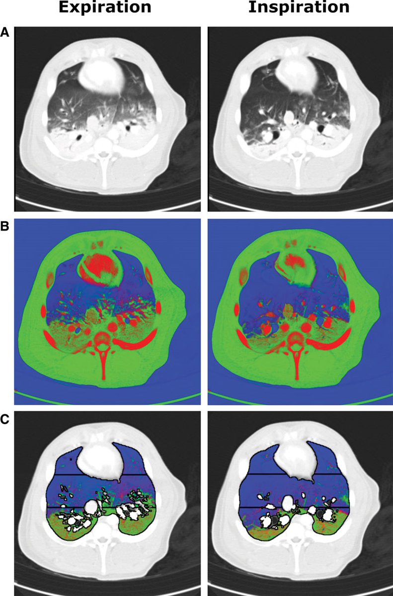 Formenti et al: Atelectasis in exp lung injury- insp breaths redistribute lung bld vol to poorly ventilated regions, worsening oxygenation.

Link: ow.ly/GvR850yn7Gz

<a href="/SCCM/">SCCM</a> #CritCareMed #ARDS  <a href="/john_n_cronin/">John Cronin</a>

Editorial
journals.lww.com/ccmjournal/Cit…

Fig: Example dual-energy CT