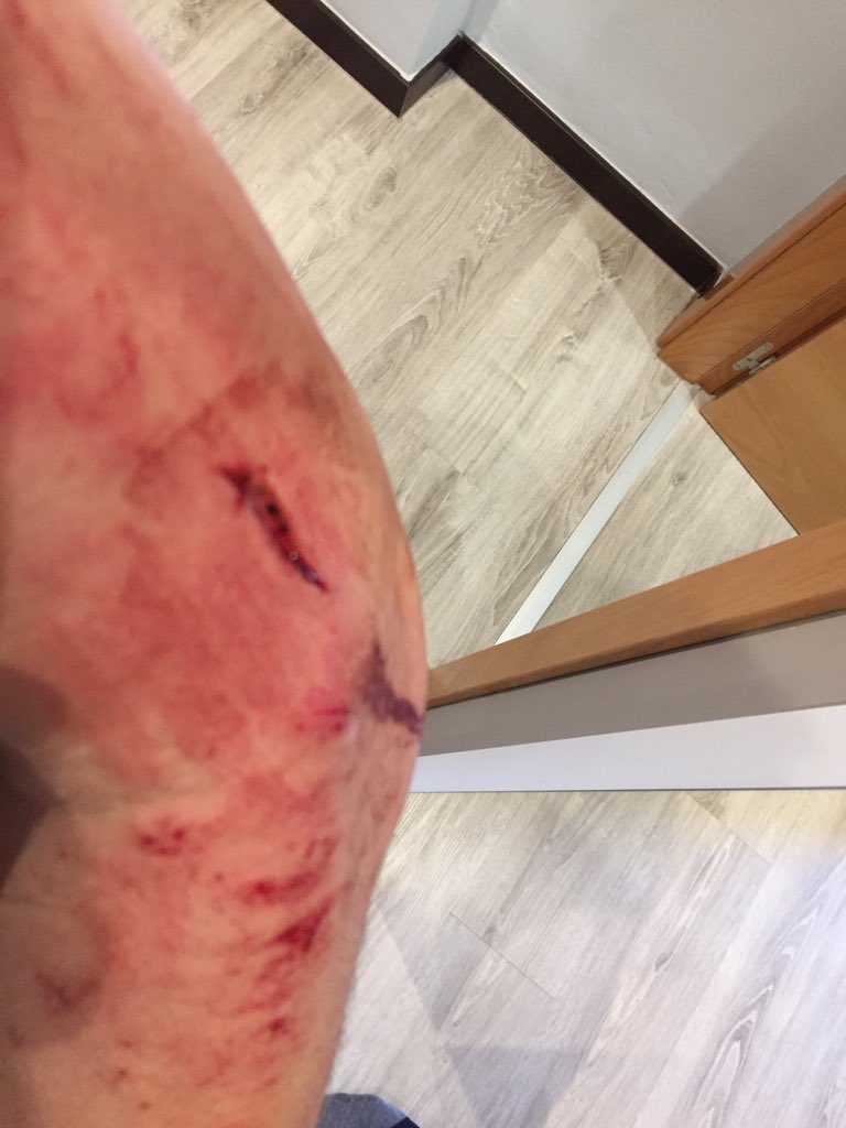 ShaneCycles's tweet photo. Butchers bill after an unplanned dismount #CTRLALTDELETEtour day 1. No show stoppers but the trip just got complicated and a little more challenging than I intended. #fuckinggravity. https://t.co/hHOuZE7K4j