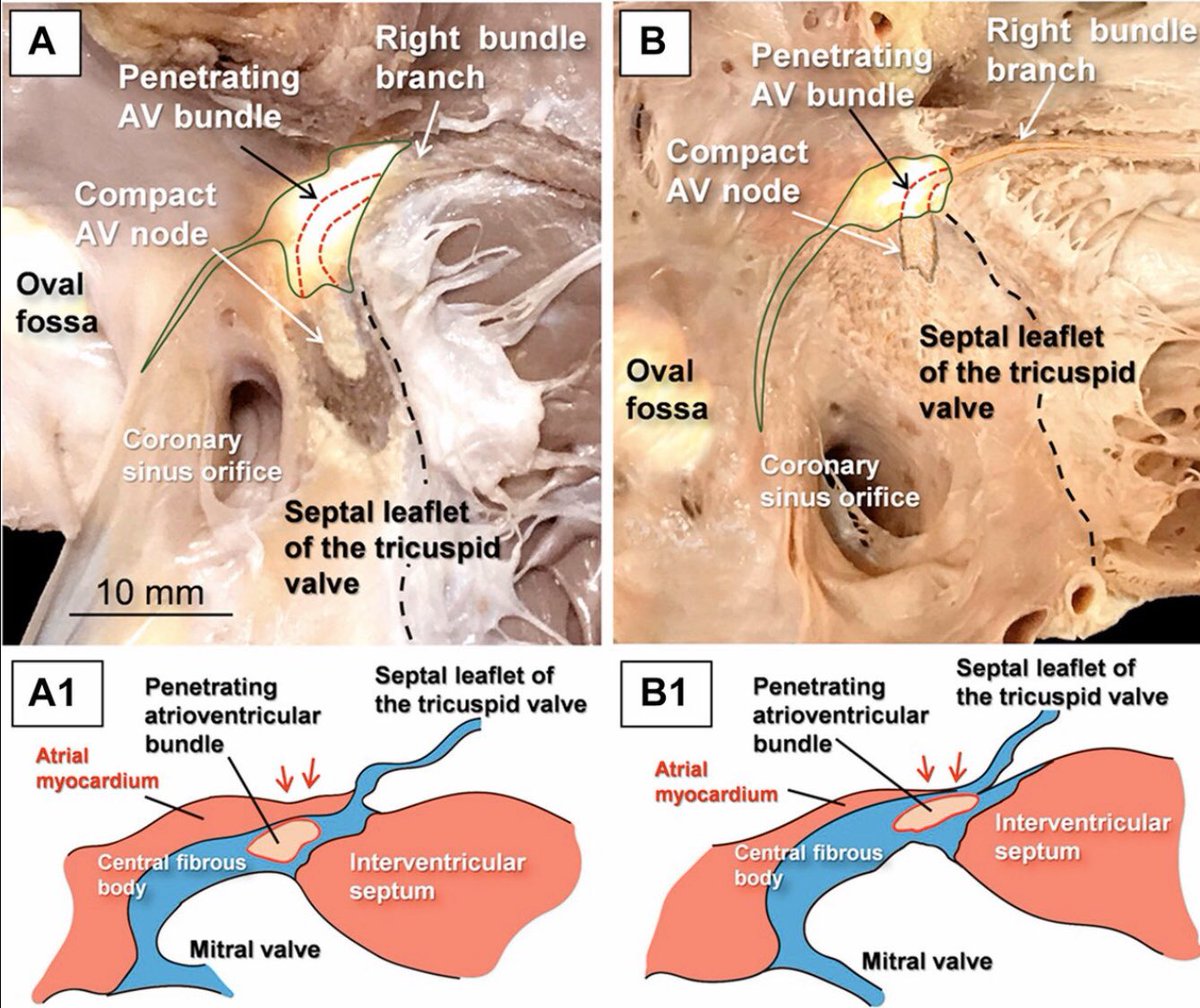 jacabreracardio's tweet photo. Sharing our recent anatomic &amp; angiographic study of the 🔹AV conducción axis 👉Implications for Permanent His Bundle Pacing https://t.co/n84jhjGf2n @DrFerminGarcia @adribaran @Hisdoc1 @DrRoderickTung @aportasanchez @OCanoPerez @JACCJournals @hisbundlepacing @shivkumarmd @JGrapsa https://t.co/AU50LyDTeV