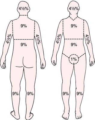 afidbrilliana's tweet photo. Kumpulan "Rule of" di bidang Bedah.

1. Wallace Rule of Nine / Burn Injury for Adults
Ada 11 part x 9 = 99%
Perineum = 1%

Notes:
• Versi lebih detail (Infant) pakai "Lund and Browder Chart"
• Luka <15% atau >85%, pakai "Palmar Method". Palmarnya pasien. Detail di gambar. https://t.co/t8mAYtrWg6