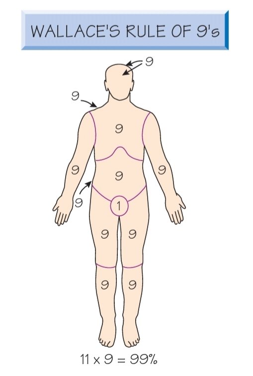 afidbrilliana's tweet photo. Kumpulan "Rule of" di bidang Bedah.

1. Wallace Rule of Nine / Burn Injury for Adults
Ada 11 part x 9 = 99%
Perineum = 1%

Notes:
• Versi lebih detail (Infant) pakai "Lund and Browder Chart"
• Luka <15% atau >85%, pakai "Palmar Method". Palmarnya pasien. Detail di gambar. https://t.co/t8mAYtrWg6