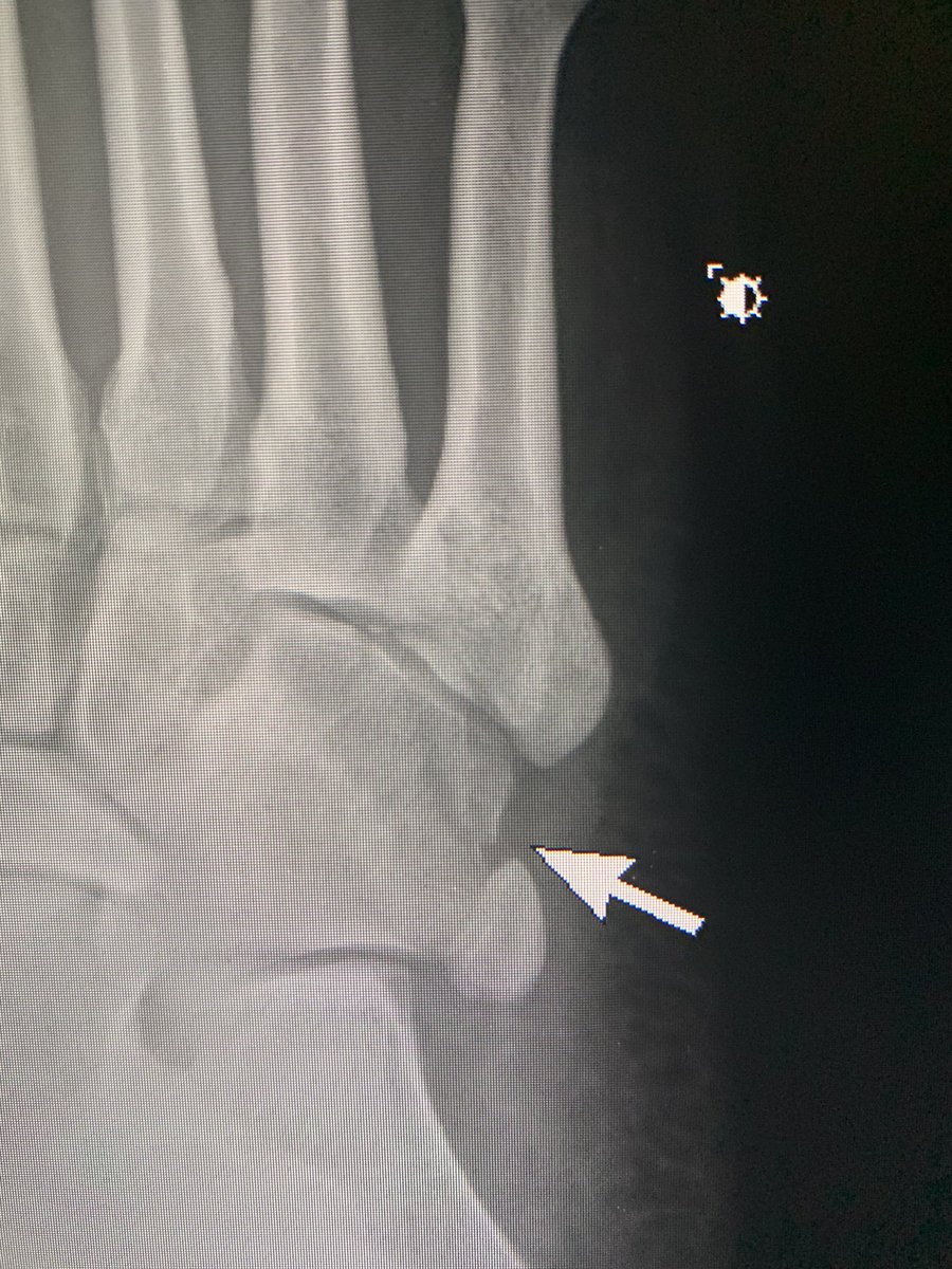 danortizmd's tweet photo. Don’t forget about the cuboid when looking at foot xrays. #mskrad #edrad #genrad #orthopedics #radres #podiatry https://t.co/RRbjirErGf