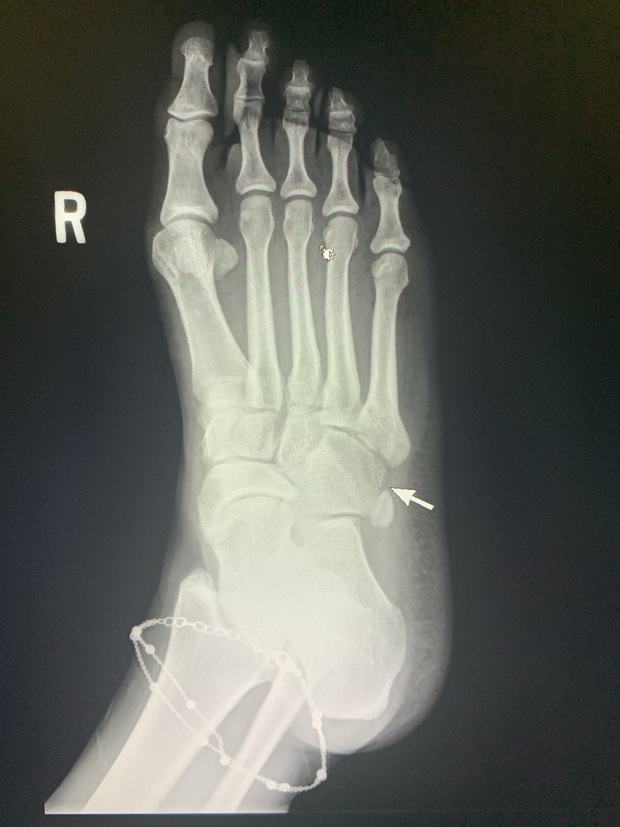 danortizmd's tweet photo. Don’t forget about the cuboid when looking at foot xrays. #mskrad #edrad #genrad #orthopedics #radres #podiatry https://t.co/RRbjirErGf
