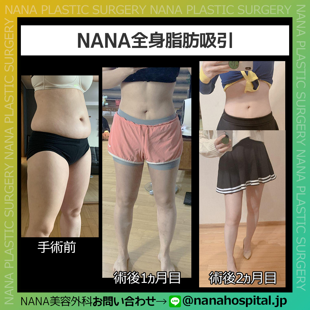 ট ইট র 韓国nana美容外科 Nana脂肪吸引 ダイエットでは落とし切れない 頑固な脂肪は 脂肪吸引で解決 皆さん 夏までに準備しましょう 公式line T Co Izcf9xg49p 韓国整形 脂肪吸引 太もも ダイエット T Co 1hf8w6b5cz