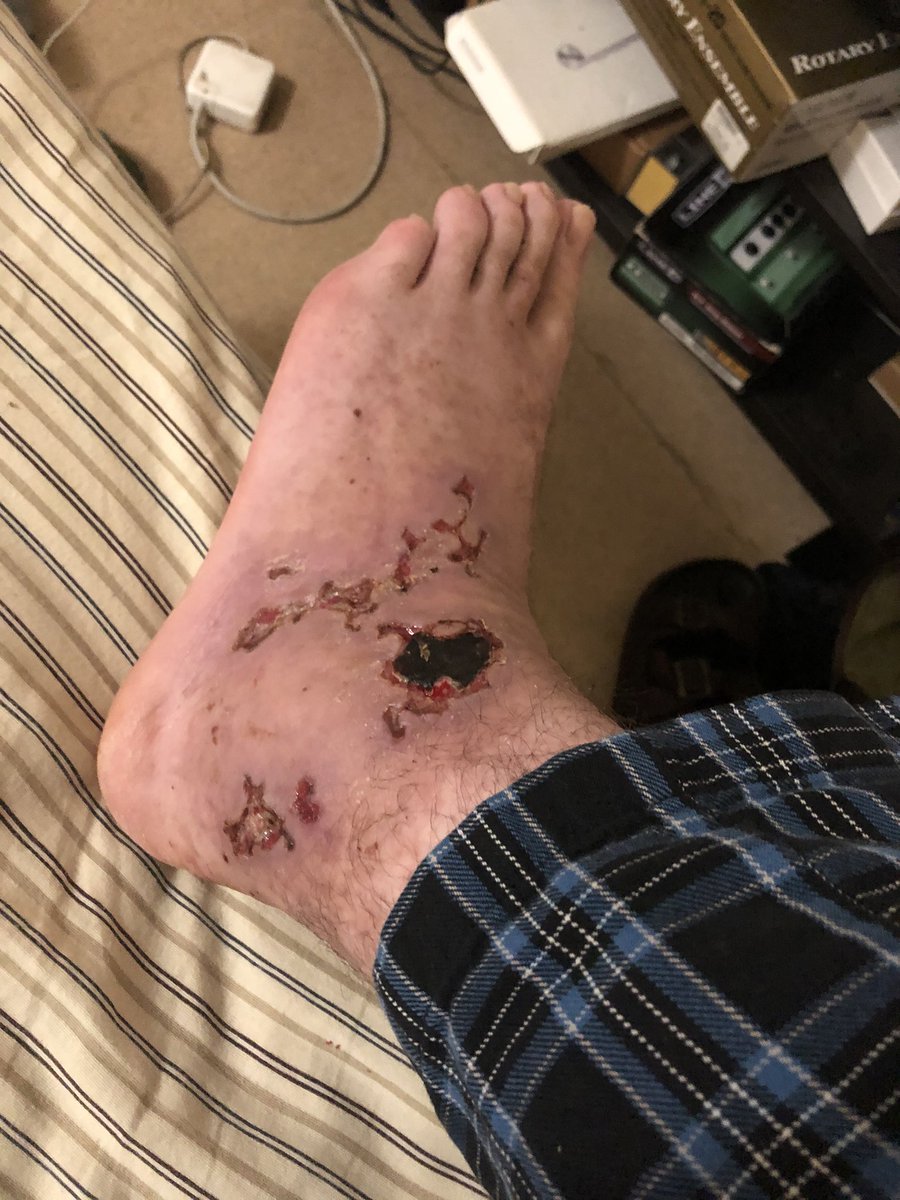 I’m mostly dealing with the aftermath of the blisters now along with joint pain. It’s quite intense looking so don’t if you can ovoid it  #feetthread  #autoimmune