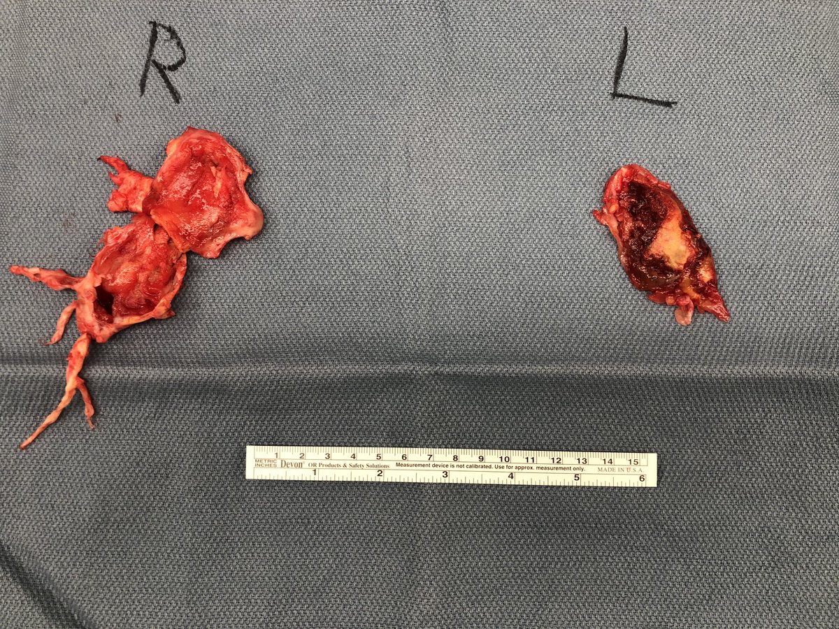 Pulmonary Artery Thromboendarterectomies!  Department of Cardiovascular Surgery #AllSaints #Fortworth #MondayMotivaton