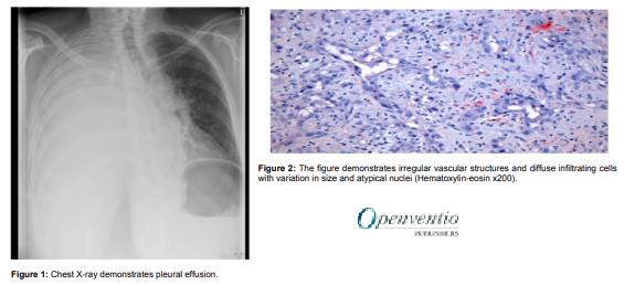Prrmojeditor's tweet photo. #casereport Hemothorax Caused by Primary Pulmonary Angiosarcoma: https://t.co/LapUYIBD27

Please RT!

#Lungcancer #Intrathoracicbleeding #Hemothorax #Acutelunginjury #Interstitiallungdisease #Lungtransplantation #Pulmonaryrehabilitation #Lungfibrosispneumonia https://t.co/TO9dcSOGDL