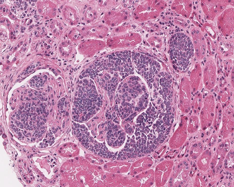 Renalpathsoc tweet picture