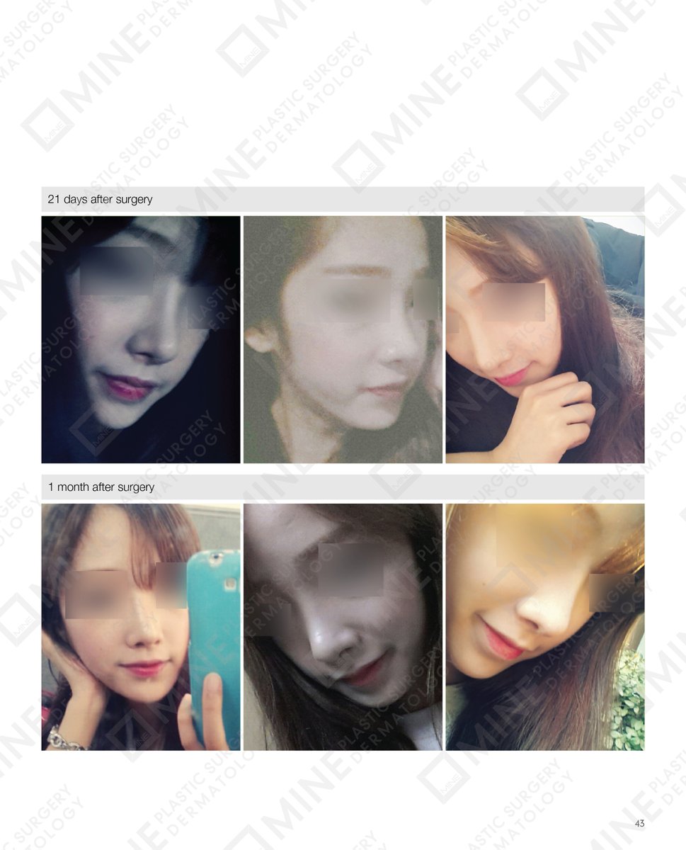 minepskr's tweet photo. #Real_Story

Patients Before &amp; After Photo on #Rhinoplasty surgery in Mine Clinic.

Look at the image below. 👇

Email us
🔹𝐄𝐦𝐚𝐢𝐥: info@mineclinic.com

#Rhinoplastysuregry #mineps
#Beautifulnose #nosejob #rhinoplastycost #rhinoplastyrecoverytime #profile #nosebeauty https://t.co/y6Ep6kSHAL