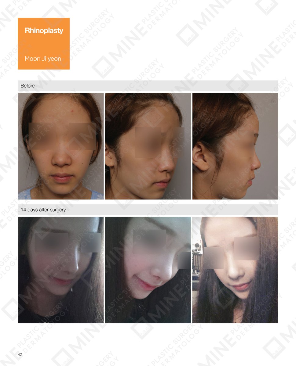 annasofea01's tweet photo. #Real_Story

Patients Before &amp; After Photo on #Rhinoplasty surgery in Mine Clinic.

Look at the image below. 👇

.
Email us
🔹𝐄𝐦𝐚𝐢𝐥: info@mineclinic.com

#Rhinoplastysuregry #mineps
#Beautifulnose #nosejob #rhinoplastycost #rhinoplastyrecoverytime #profile #nosebeauty https://t.co/Ho2L2dHfJC