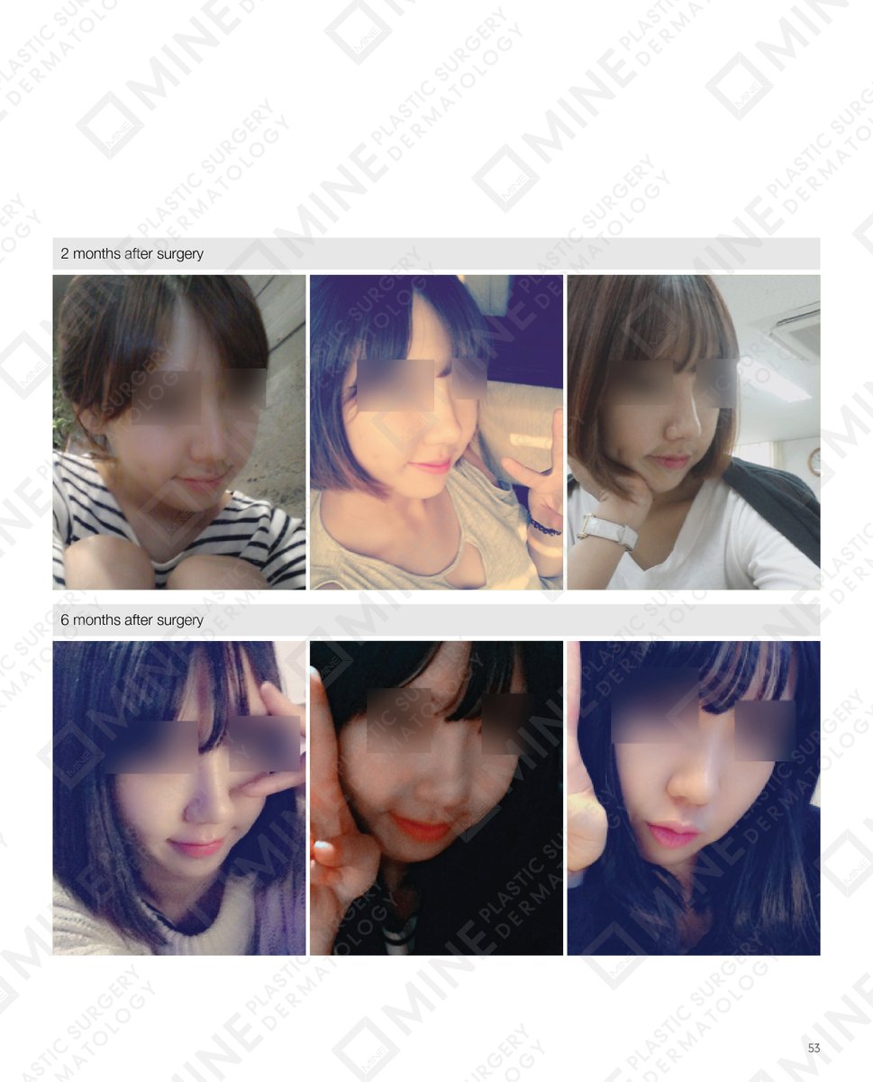 minepskr's tweet photo. #Real_Story

Patients Before &amp; After Photo on #Rhinoplasty https://t.co/mWZl7MrO7X