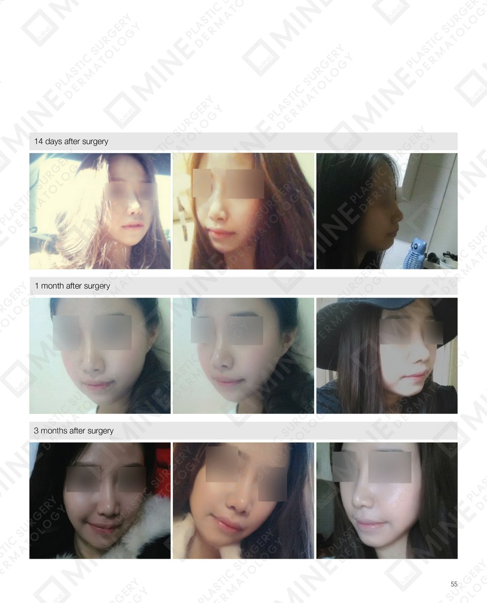 minepskr's tweet photo. #Real_Story

Patients Before &amp; After Photo on #Rhinoplasty https://t.co/mWZl7MrO7X