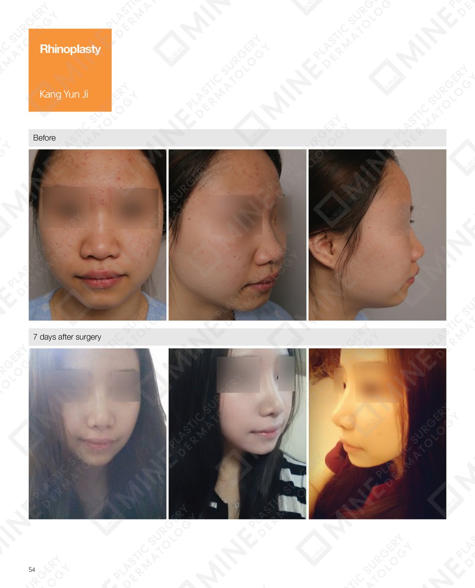 minepskr's tweet photo. #Real_Story

Patients Before &amp; After Photo on #Rhinoplasty https://t.co/mWZl7MrO7X
