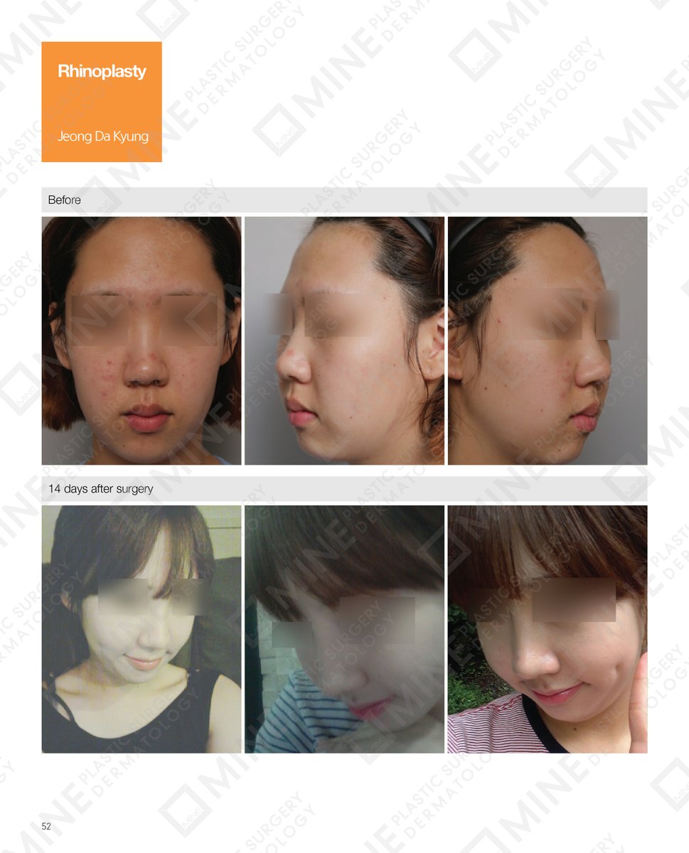 minepskr's tweet photo. #Real_Story

Patients Before &amp; After Photo on #Rhinoplasty https://t.co/mWZl7MrO7X