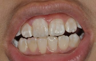 BalsallDental's tweet photo. What to Do About White Spots On Your Teeth - Read more in our blog - https://t.co/mAqlIT4vGV https://t.co/pvQkhneNxT