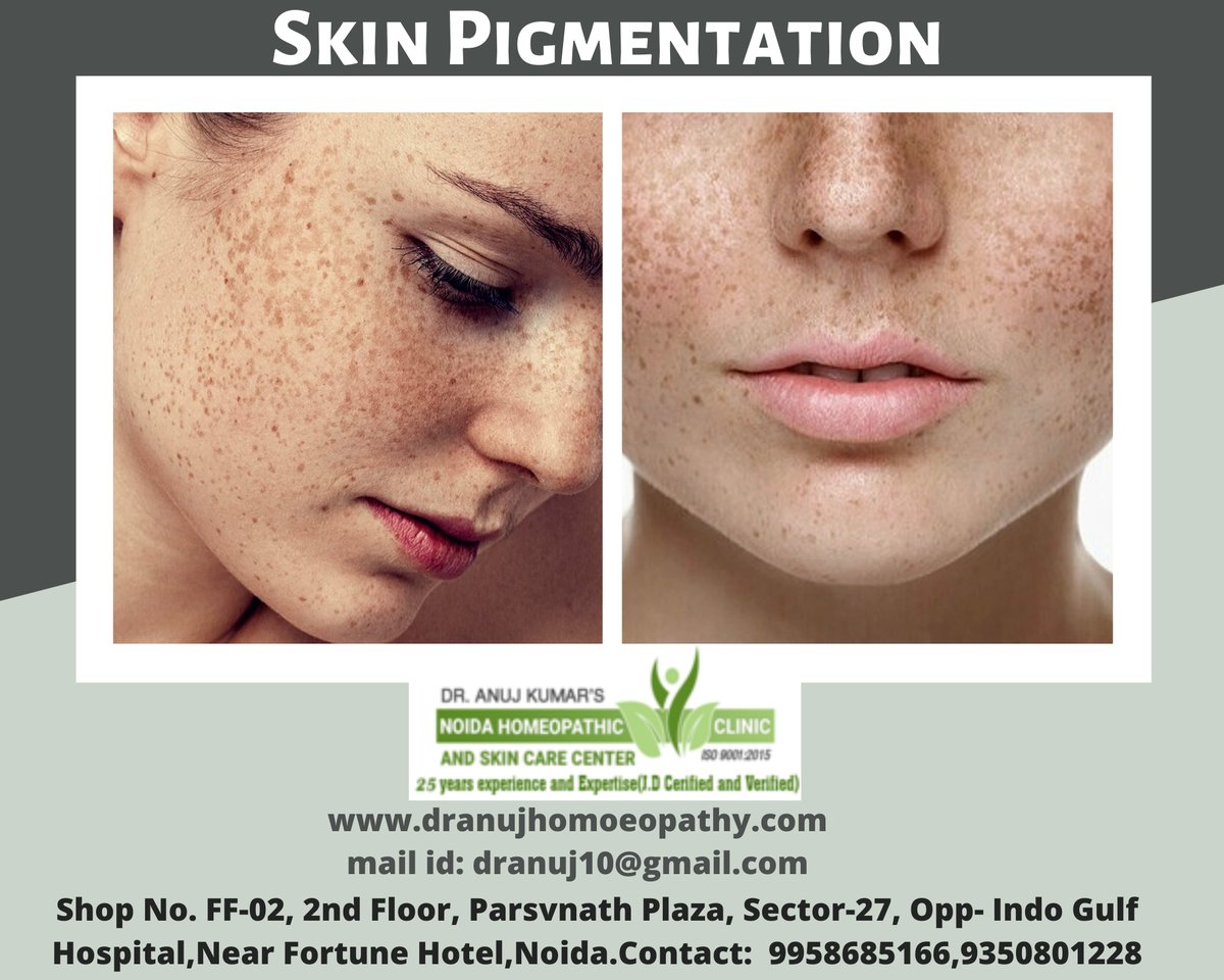 Pigmentation is the condition referring to the changing colour of skin. Experiencing any darkening of your skin colour? Visit Dr. Anuj Kumar’s Noida Homeopathic Clinic & Skin Care Center to get the even tone of your skin.

#pigmentationremoval 
#besttreatmentPigmentation