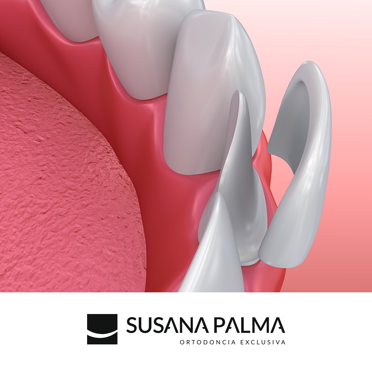 El tratamiento de carillas dentales es una de las técnicas más empleadas en estética dental. Con ellas podemos cambiar la forma de los #dientes, el color o incluso corregir alguna fractura.  Consigue tu sonrisa ideal reservando en el 926 21 24 20. 

ortopalma.com/tratamientos/e…