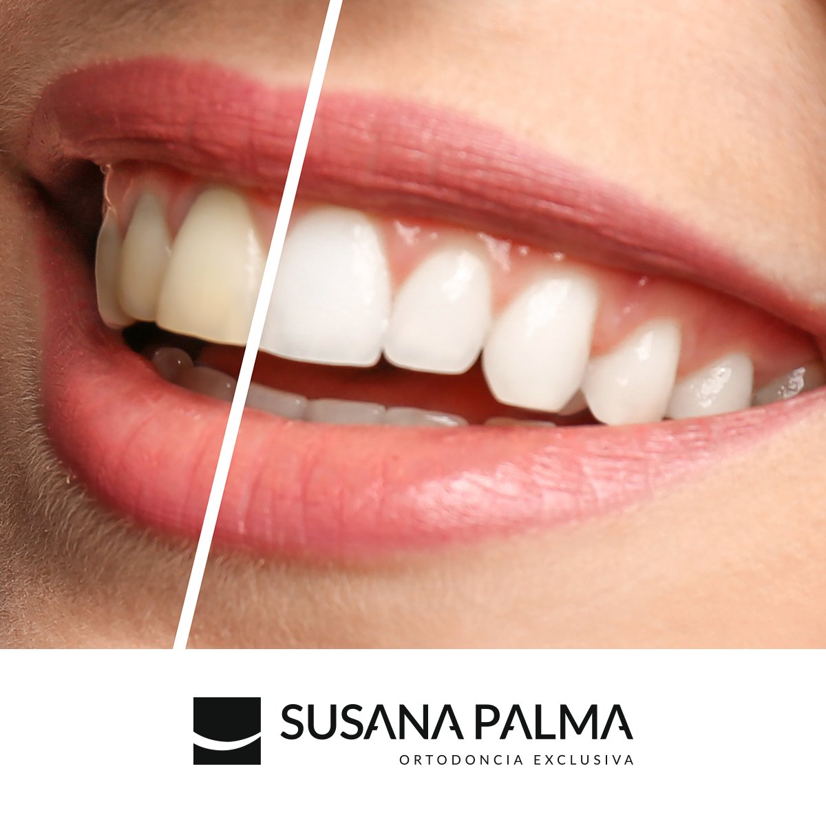 Una gran #sonrisa es la mejor carta de presentación, por ello el blanqueamiento dental es uno de los tratamientos más demandados. ¿Estás pensando en hacerte uno?
Confía en nuestros profesionales para conseguir unos resultados esperados.

ortodonciaciudadreal.com/solicitar-cita/