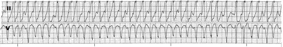 ecgrhythms's tweet photo. An exciting rhythm from the archives

A 25 yo p/w palpitations. 

#FOAMed #meded #cardiology #cardiotwitter #Epeeps 
#PreexcitedAF #ecgarchives #medstudenttwitter #NurseTwitter 

Cardioverted >>> ablation. https://t.co/uZbkifIjLy