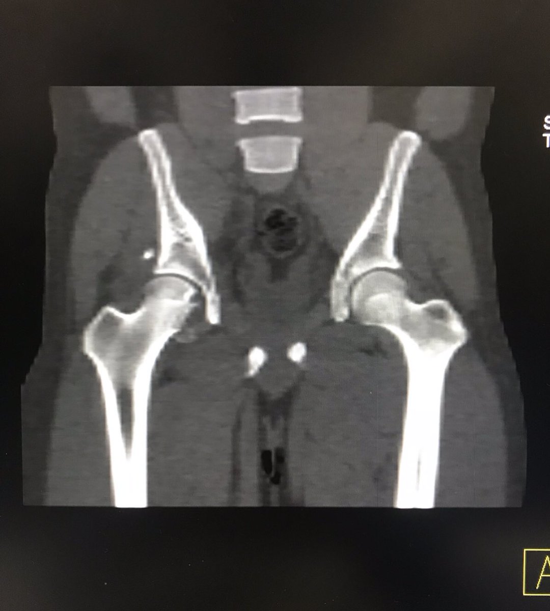 Ncube_Ortho's tweet photo. #orthotwitter , #hiparthroscopy , #orthotrauma Any thoughts on how to tackle this. 30yr/M, MVA, Rt posterior hip dislocation reduced, stable post reduction, intact sciatic nerve. Non-op?, Reconstruct? Ant or Post approach?,Surgical hip dislocation?Arthroscopy? https://t.co/2kVrZSHwct