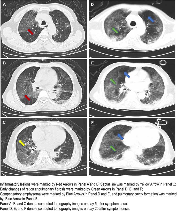 Dr_Cit's tweet photo. Imaging changes of severe COVID-19 pneumonia in advanced stage on  @youricm at https://t.co/bNuGReBUF4 https://t.co/VOT0jOk0bZ