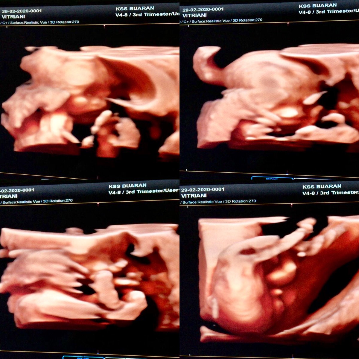 shakira_khabib's tweet photo. Thanks God. for give me a little brother πΆπ»
#babygirl #babyshakira #shakirayakcob #bayicantik #bayipintar #bayisehat #bayilucu #babyjamannow #mylittlegirl #kinakinu #minyupichu #kehamilansehat #kehamilansehatdurensawit #hdlive4d #littlebrother https://t.co/JmwQRTOWqv