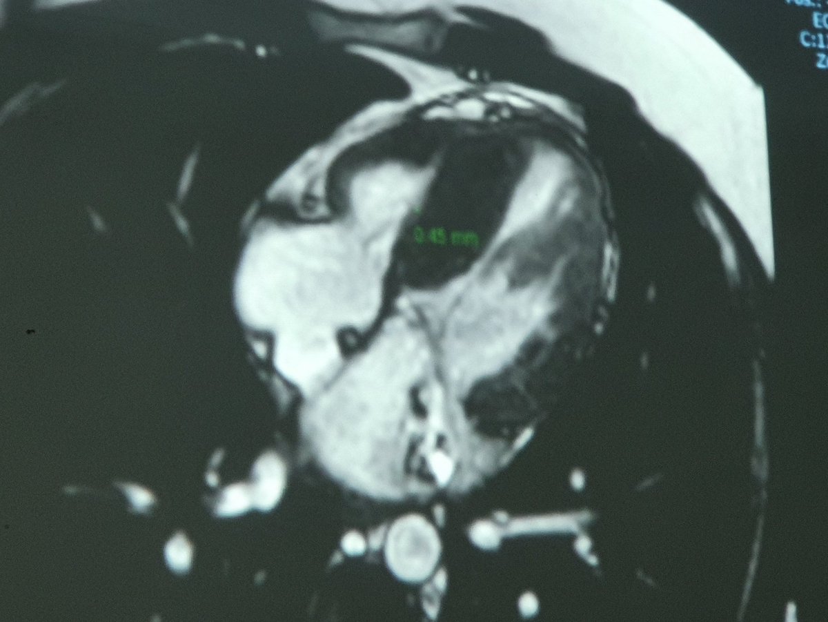 CicytS's tweet photo. Caso de miocardiopatía hipertrofica septal. #insuficienciacardiaca #CICyTSXXI #hospitaldecardiologiacmnsxxi https://t.co/4HJmNs0TJs