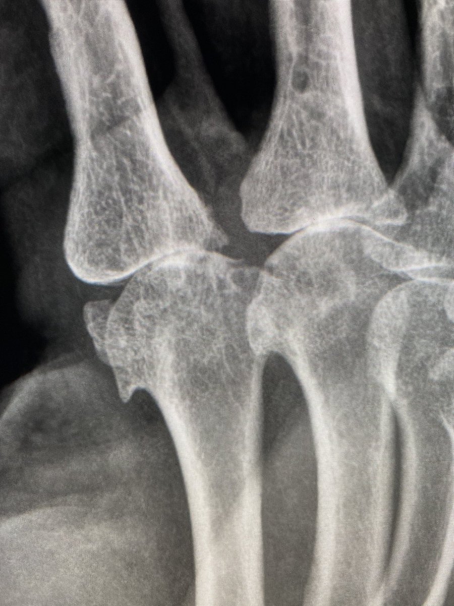 “Hook” Osteophyte of the Metacarpal Head seen with:

1. Hemochromatosis: uniform MCP joint space loss including 4th and 5th fingers. Assoc. Osteopenia.

2. CPPD: MCP joint space loss primarily at 2nd and 3rd fingers. Assoc. Chondrocalcinosis

This case - CPPD

#radres #mskrad