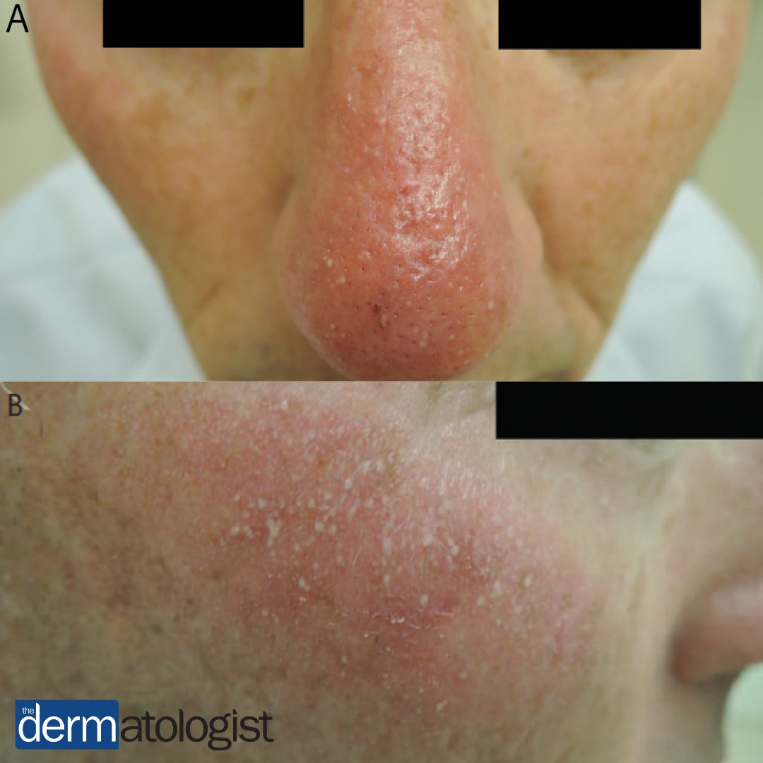TheDermEditor's tweet photo. Think you know what caused these pustules on a 62-year-old man? Check your diagnosis with our latest #DermDx: https://t.co/1OsYSwHrMl https://t.co/WcO2eDkuzH