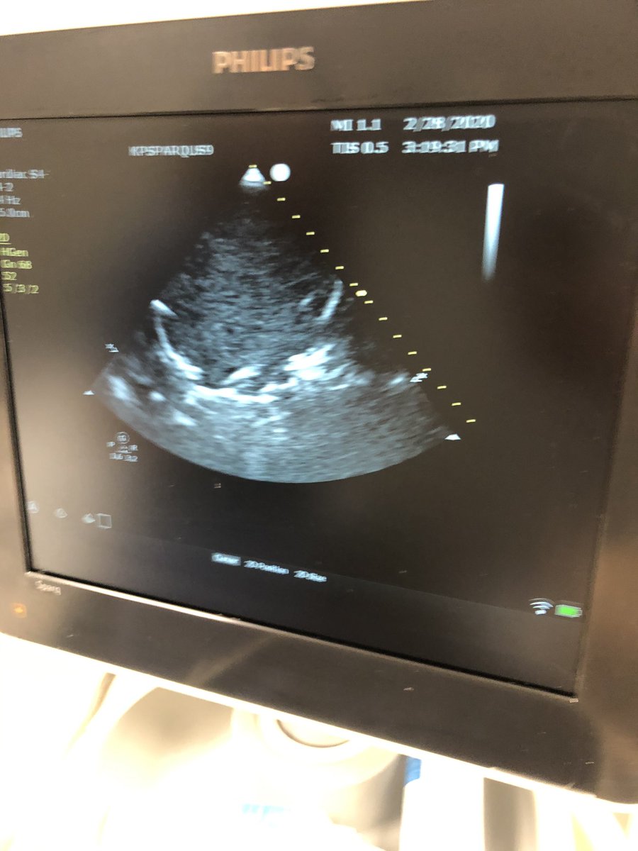 jameshorowitzmd's tweet photo. Teaching pericardiocentesis #PAC20 w home made lo-fi mannequin! Gets the job done and u can even #pocus it! #simulationDYI 
“Bloody” fluid courtesy of @Gatorade https://t.co/d5mKTi1ti9