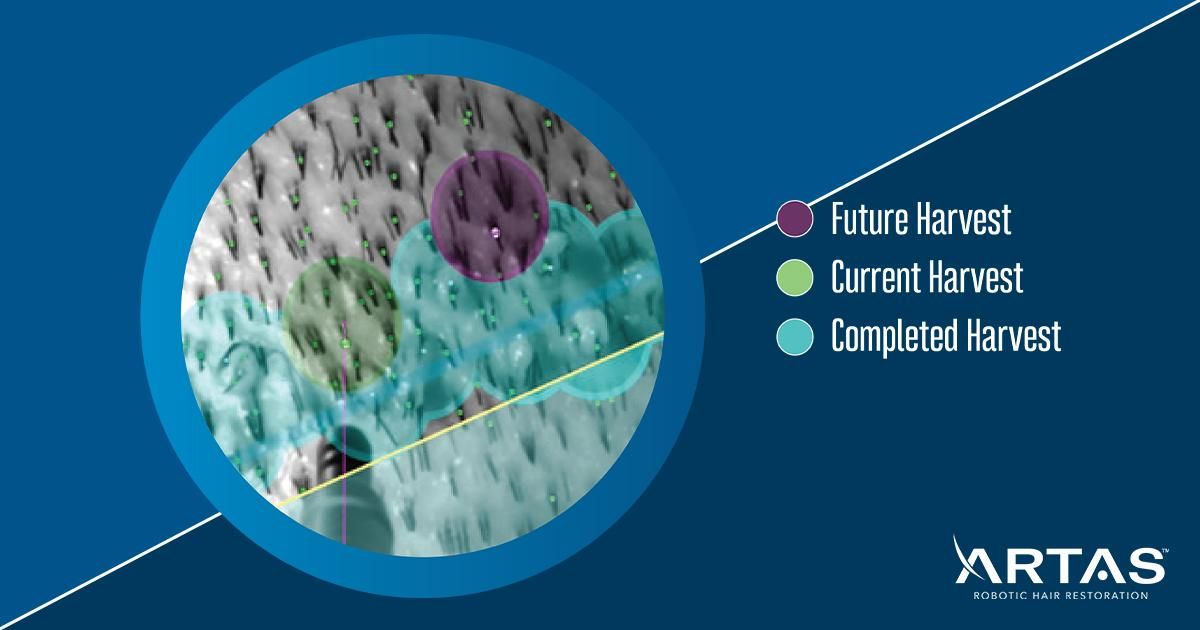 Bientôt disponible en France !!
ARTAS iX™ est le seul système de restauration capillaire au monde qui combine la robotique et l'Intelligence Artificelle pour fournir des résultats naturels et une technique d'extrême précision buff.ly/2IcReLJ
#ARTAS #ArtasiX #VenusConcept
