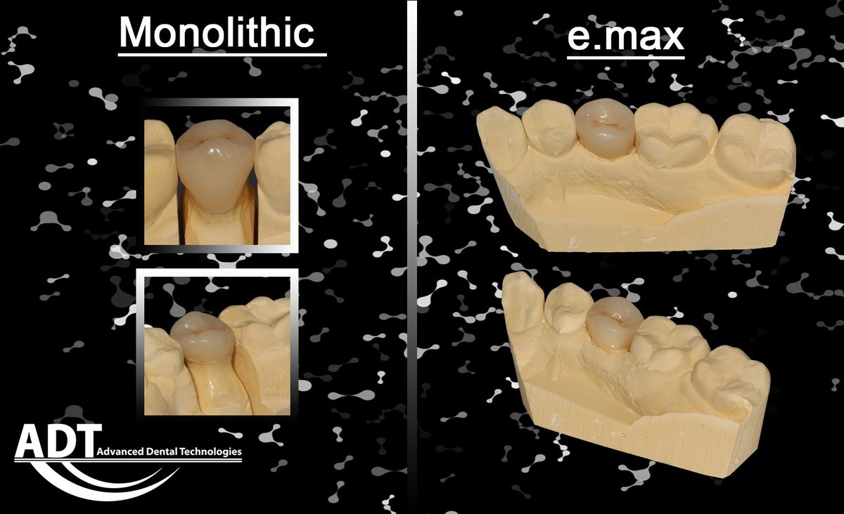 AdvDntlTech's tweet photo. https://t.co/QMugcUnJ42

#ADT #AdvancedDentalTechnologies #AdvancedDentalLab #emax #LoveOfTeeth #ToothArt #Dentistry #Dental #SendUsYourScans #SendUsYourImpressions https://t.co/3P5rOty2xo