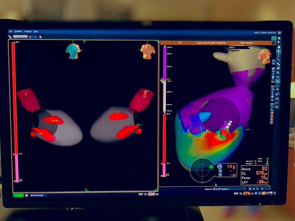 #HDGrid localized this #PVC to the posterior septal aspect of the Mitral Annulus. #ZeroFluoro @AbbottCardio @forkknifecab_EP