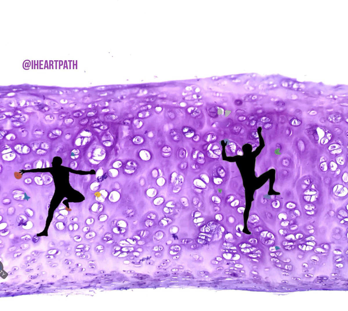 iheartpath's tweet photo. Rock climbing in a benign cartilaginous tissue #pathart https://t.co/gBGmJKjDBh