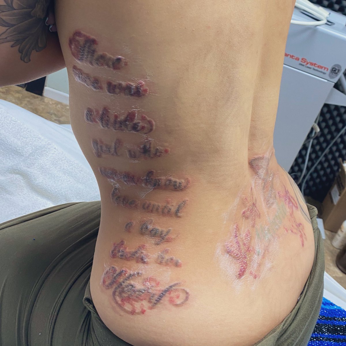 _cweeed's tweet photo. Seventh session healed for my back. Fourth session healed for my ribs.
Immediately after eighth and fifth sessions πβΊοΈ #lasertattooremoval #freedomlaser ππΌ https://t.co/ZxVGFea0VV