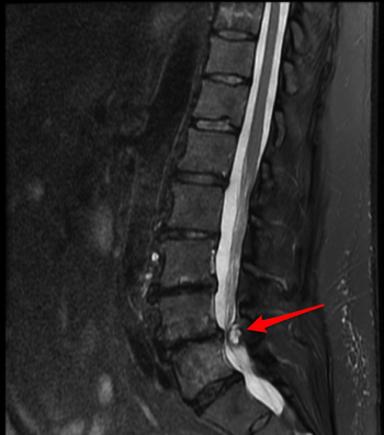 SpinalConfusion's tweet photo. The Truth About Facet Cysts https://t.co/IGCXsDTzOF https://t.co/siqRUJymht