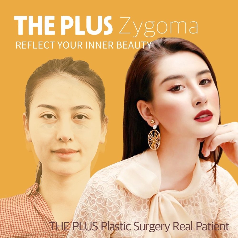 theplusps's tweet image. 🔺 Real Model Event of THE PLUS Plastic Surgery 🔺
Currently we have the promotional events as the following:

1. Facial Bone Contouring Surgery Real Model Event
bit.ly/2V0VkdT
2. Breast Augmentation Surgery Real Model Event
bitly.com/2UQwiBP
#ThePlusplasticsurgery