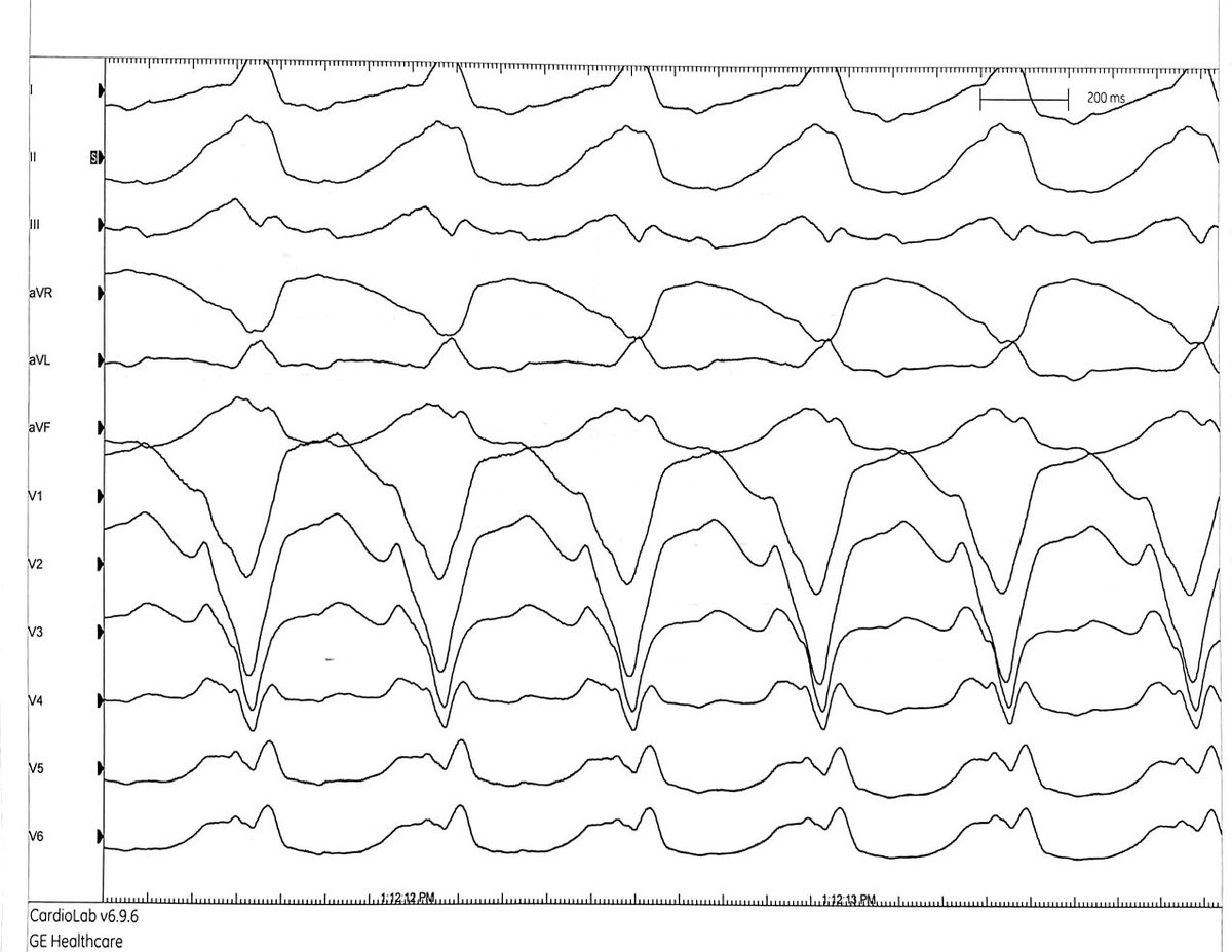 saundersjustin's tweet photo. @mustafa_omarov @Hapa_EP Fair question, I think activation map doesn’t do it justice. The clinical tach has late precordial transition, which could still be manifest NF, PAC terminates tachycardia without affecting septal atrial activation. https://t.co/JZb8epqhWr