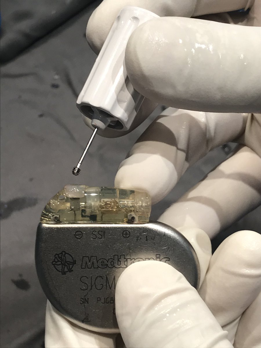 UlhasDr's tweet photo. When wrench disengages setscrew from connector port! @SchakrabartiEP @narrowQRS @rdschaller @ecgrhythms @ecgguru @drnjy @SuchitMajumder @DCR_Dr @Vadeboncoeur_Al @Hapa_EP @PaymardM @chaturvedimd @Epeeps_Bot @KakkamKrishna @AparnaBalaji4 https://t.co/1lh1XWRWEW