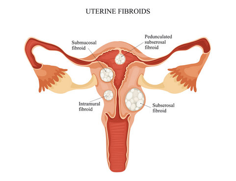 gift_ivf's tweet photo. Should I remove fibroids to attain pregnancy?

Read the blog to know more:https://t.co/6ic6kt7cWK

#fibroids #pregnancy #kerala https://t.co/A9htq7AbXE