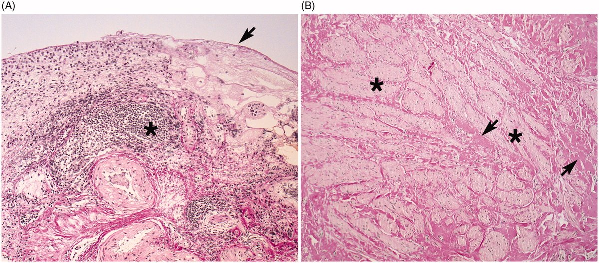 ScanJourUrol's tweet photo. Hunner lesion disease differs in diagnosis, treatment and outcome from bladder pain syndrome #InterstitialCystitis
#Bladderpainsyndrome #ESSIC https://t.co/dO5A4ZKLCr https://t.co/66PPA9dDkj